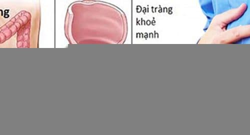 Bệnh viêm đại tràng kiêng ăn gì là thắc mắc chung của nhiều người khi bị bệnh