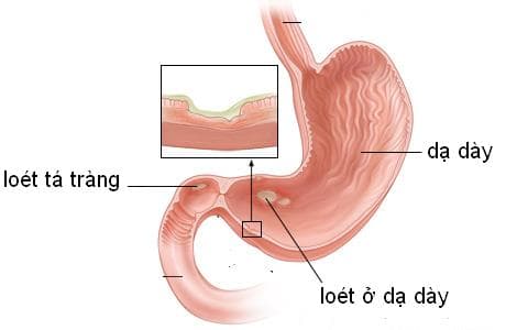 Các nguyên nhân gây bệnh viêm loét dạ dày tá tràng rất đa dạng