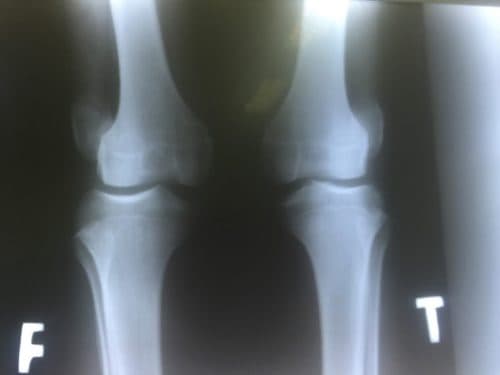 Bị trật khớp gối phải làm sao để nhanh khỏi?