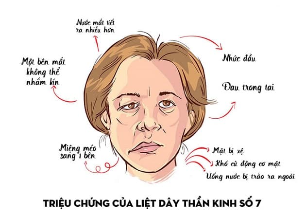 biểu hiện liệt dây thần kinh số 7