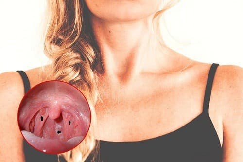 Ung thư vòm họng là bệnh hay gặp ở nước ta thuộc nhóm bệnh ung thư ở vùng đầu – mặt – cổ