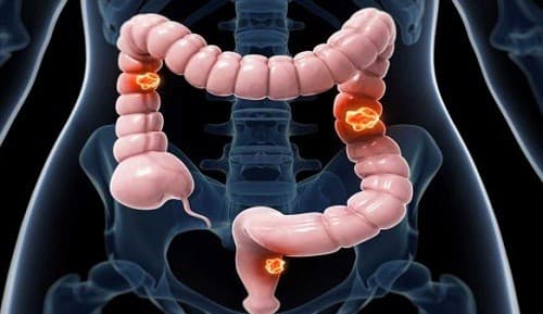 Ung thư đại trực tràng cũng là một trong số các bệnh ung thư thường gặp ở nước ta