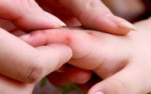 cac-bieu-hien-cua-benh-tay-chan-mieng-1