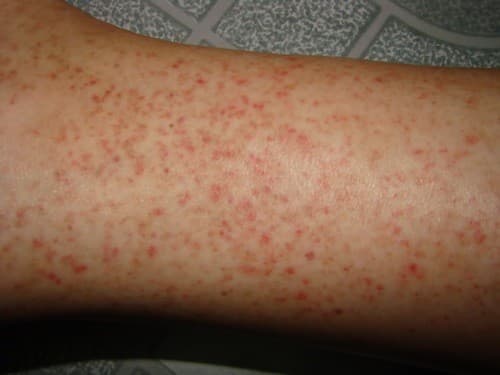 Các giai đoạn sốt xuất huyết