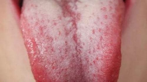 Bệnh lưỡi trắng phổ biến trong các bệnh về lưỡi 