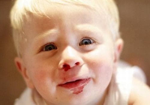 Chảy máu cam ở trẻ em