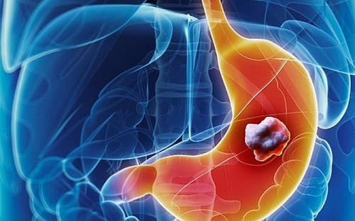 Ung thư dạ dày là bệnh lý thường gặp ở đường tiêu hóa, gây nguy hiểm tới tính mạng nếu không phát hiện và điều trị sớm