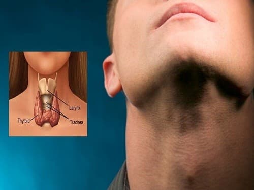Nổi u ở cổ là dấu hiệu ung thư tuyến giáp giai đoạn cuối