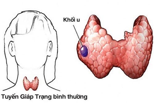 dấu hiệu ung thư tuyến giáp