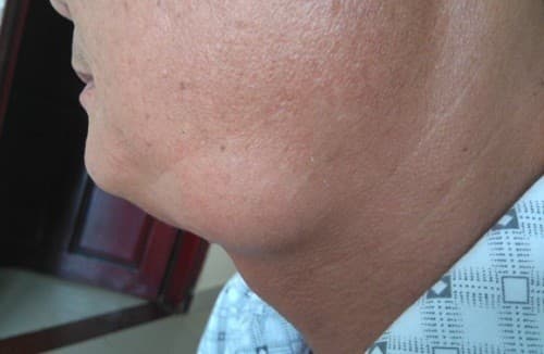 Nổi hạch ở cổ là một trong những dấu hiệu ung thư vòm họng thường gặp