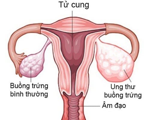 Ung thư buồng trứng thường gặp ở những phụ nữ trên 50 tuổi 