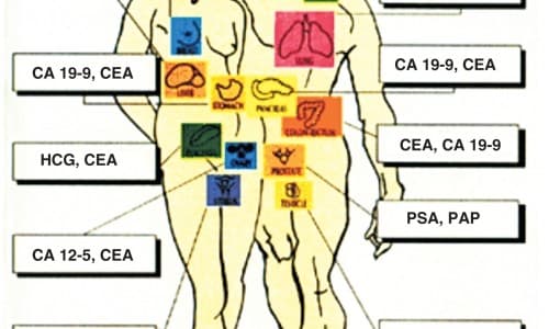Nếu nghi ngờ mắc ung thư tuyến tụy, ung thư gan hoặc tắc nghẽn ống dẫn mật thì nên làm xét nghiệm tìm CA 19-9