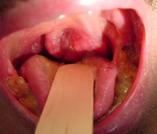 Cận cảnh hình ảnh khoang miệng có amidan bị ung thư 