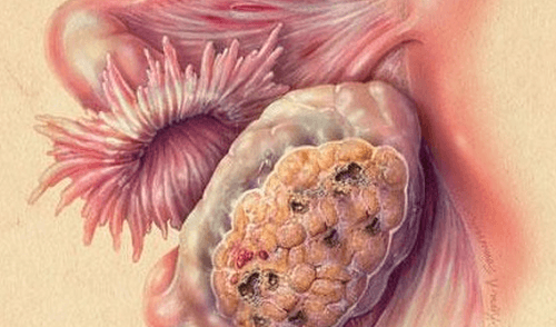 Nếu không phát hiện và điều trị kịp thời, khối u ác tính tại buồng trứng sẽ nhanh chóng phát triển và xâm lấn sang các cơ quan lân cận