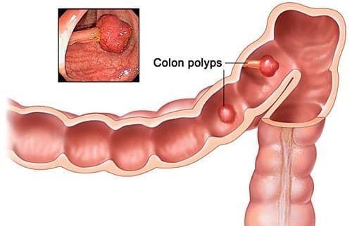 Những hình ảnh ung thư đại tràng