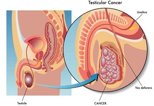 Hình ảnh ung thư tinh hoàn có mức độ nguy hiểm cao