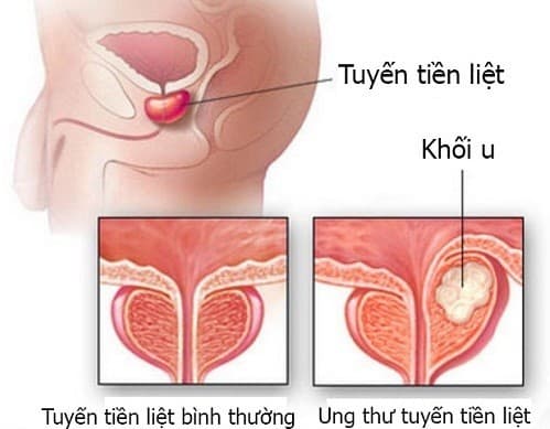 Hình ảnh ung thư tuyến tiền liệt