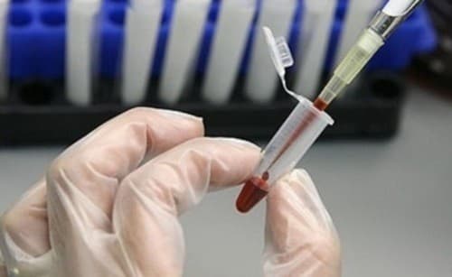 Xét nghiệm máu chẩn đoán mức độ men gan cao