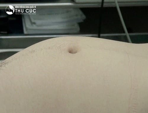 mo thanh cong khoi u to nhu bau 5 thang