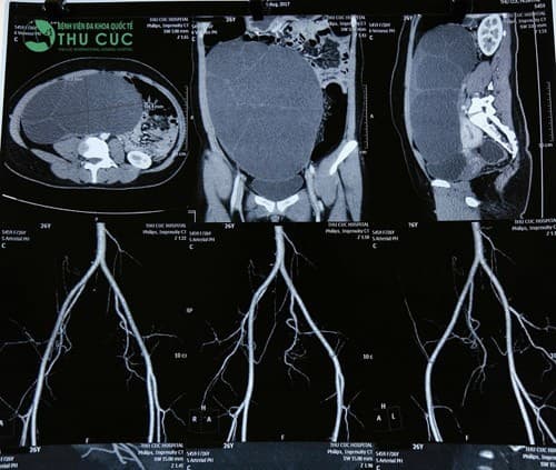 mo thanh cong u to nhu bau 5 thang