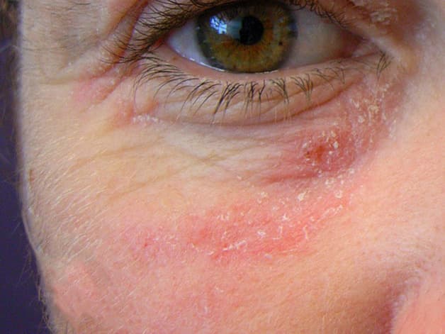 Bạn có biết ngứa mí mắt là bệnh gì không: 4 bệnh thường gặp