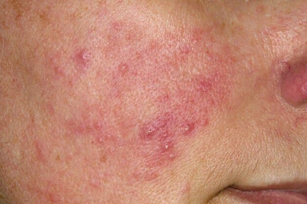 Bệnh Rosacea thường xuất hiện do yếu tố di truyền hoặc môi trường gây nên