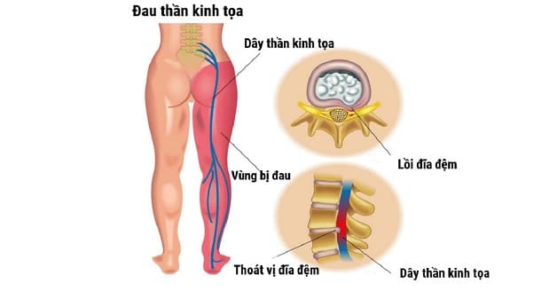 đau thần kinh tọa nguyên nhân do thoát vị đĩa đệm