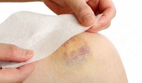 Dấu hiệu chung nhất của bệnh là hội chứng chảy máu, đặc biệt là ở da và niêm mạc.