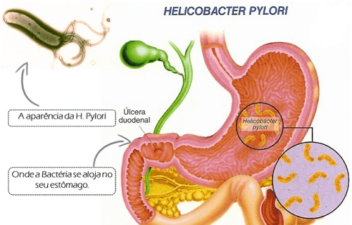 Nguyên nhân ung thư dạ dày cách phòng ngừa bệnh hiệu quả