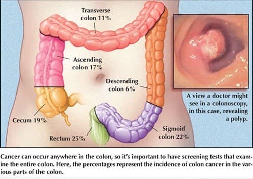 Nguyên nhân ung thư đại tràng