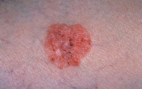 Nốt ruồi ung thư thường có đường viền bất thường