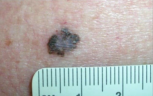 Nốt ruồi ung thư – cách nhận biết