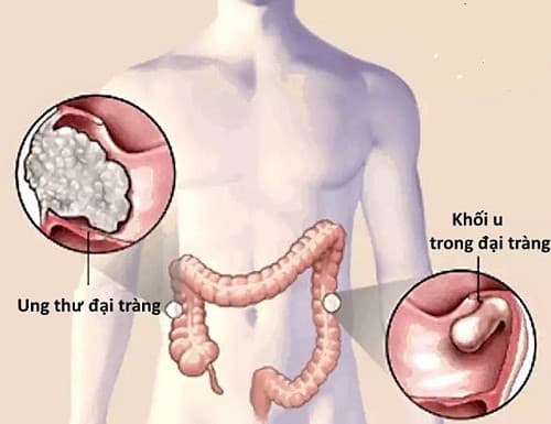 Ung thư đại tràng thường gặp ở nam giới nhiều hơn nữ trong độ tuổi phổ biến từ 30-60 tuổi.