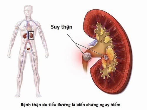 Suy thận là biến chứng nghiêm trọng của bệnh sỏi thận