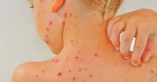 Sốt xuất huyết có được tắm không