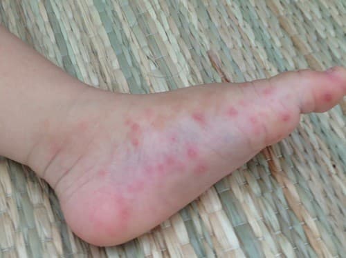 sốt xuất huyết lây qua đường nào