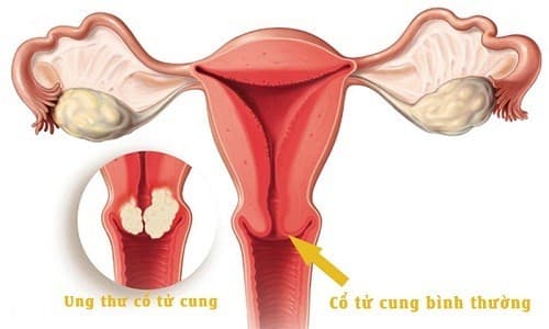 Tầm soát ung thư cổ tử cung ở đâu