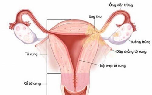 Viêm nội mạc cổ tử cung cũng có thể là nguyên nhân gây hiện tượng tiểu buốt