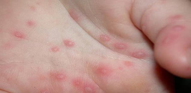 Trẻ bị tay chân miệng kiêng gì?