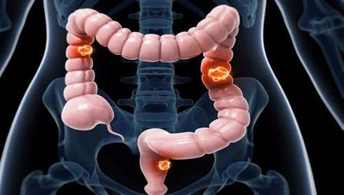 Chế độ ăn uống không hợp lý cũng là nguyên nhân gây triệu chứng ung thư đại tràng