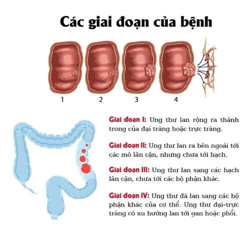 Tùy từng giai đoạn và mức độ bệnh cụ thể mà tỷ lệ điều trị ung thư đại tràng thành công khác nhau.