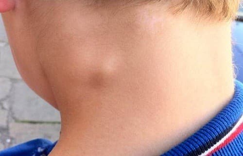 Triệu chứng ung thư hạch bạch huyết thường gặp là hạch sưng to