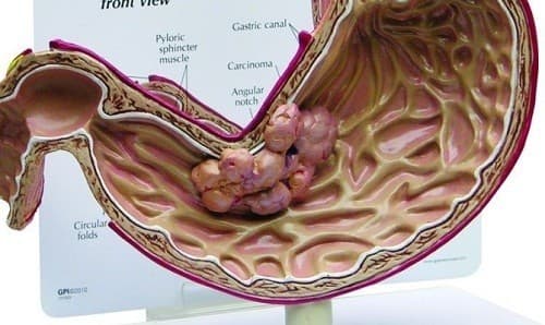 Ung thư dạ dày ở độ tuổi nào là thắc mắc được nhiều người đặt ra