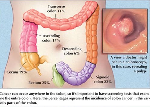 Ung thư trực tràng là bệnh ung thư về đường tiêu hóa thường gặp ở nam giới trong độ tuổi trung niên.