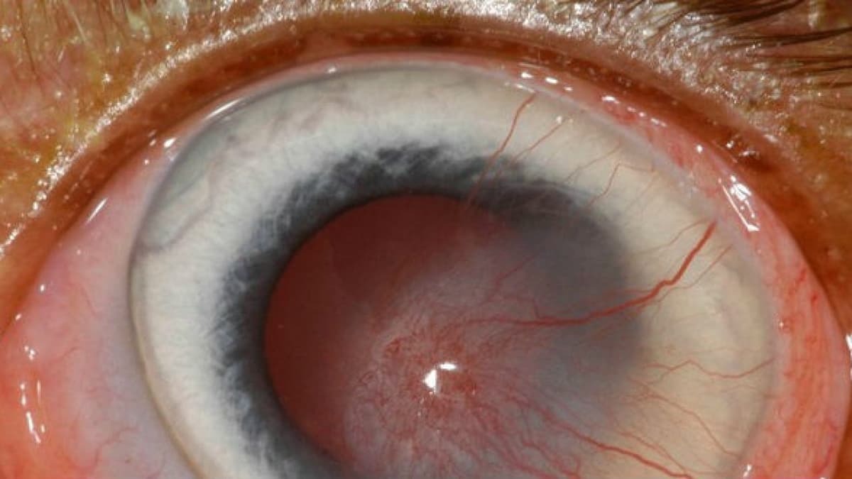 Không thể chủ quan với dị vật kết mạc