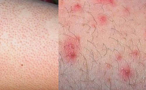 viem-nang-long-la-gi-1