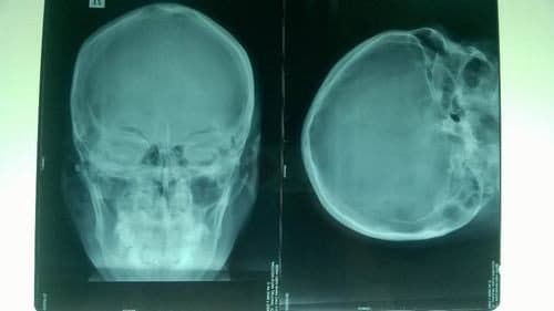 Chụp X Quang Sọ Não và Những BIẾN ĐỔI bệnh lý trên phim X quang 3