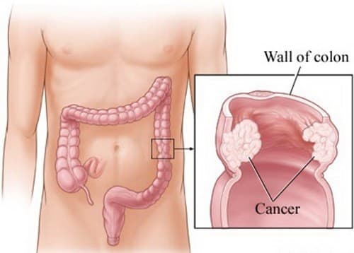 Ung thư đại tràng có khả năng điều trị thành công cao nếu phát hiện sớm