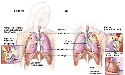 Việc xét nghiệm ung thư phổi sẽ giúp chẩn đoán được giai đoạn bệnh cụ thể, giúp hỗ trợ điều trị bệnh hiệu quả