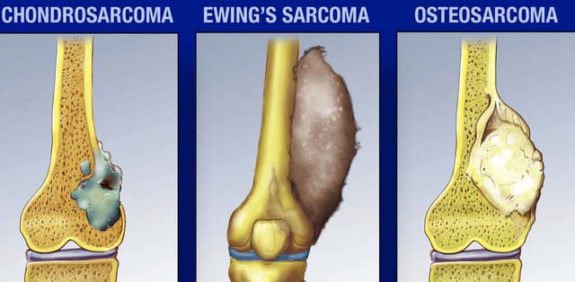 Khám và điều trị Sarcoma tạo xương